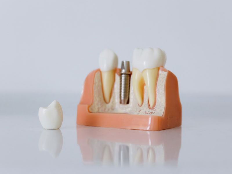 Dental Implants Experts