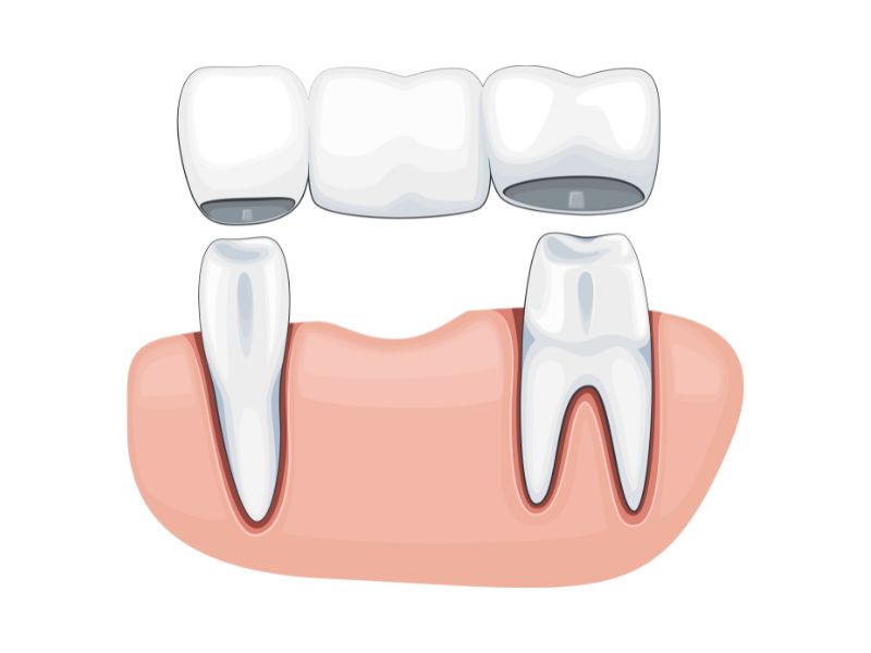 Dental Bridge