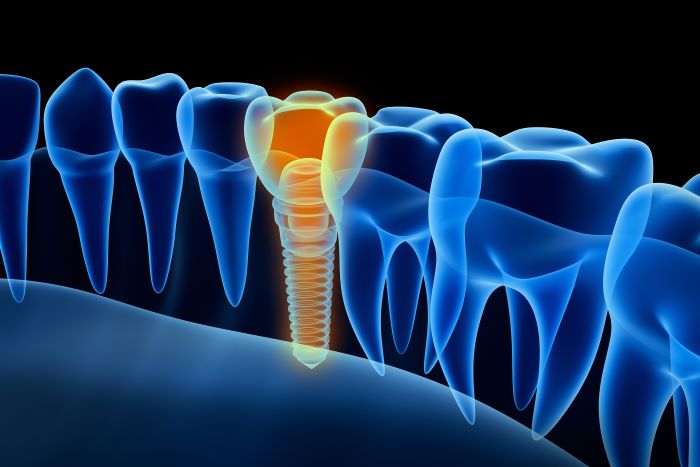 Dental Implant Specialist