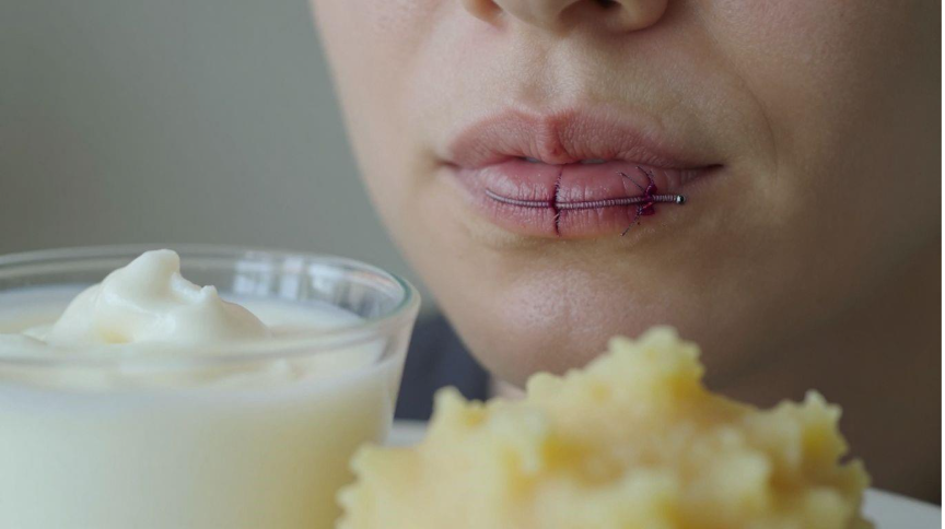 After Oral Surgery with Stitches