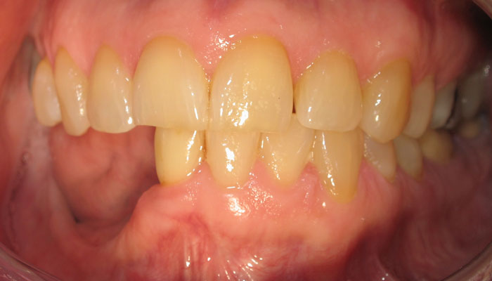 Teeth Reconstruction