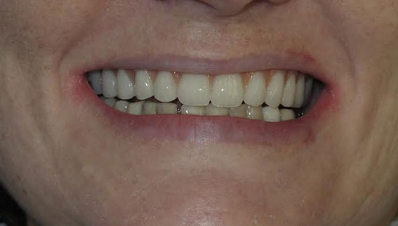 Dentures with Implants